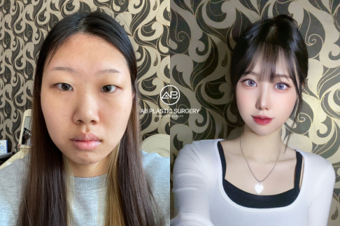 Cheek Reduction Surgery: A Comprehensive Guide to Facial