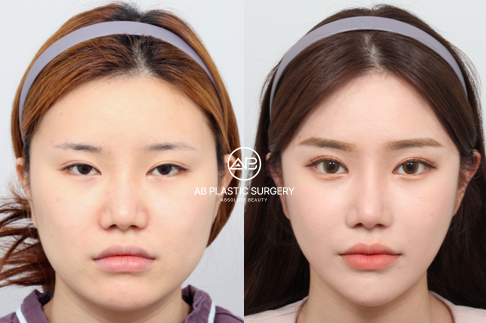 健康・医学 facial bone contouring surgery Why Choose 3-Type Facial Contouring Over Other Facial