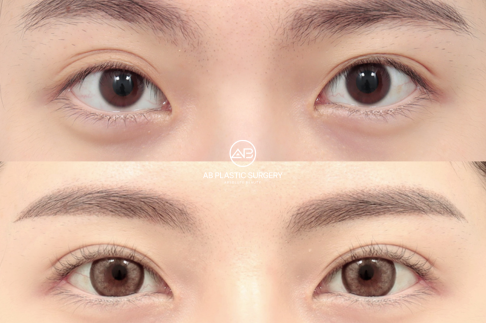 Double Eyelid Surgery: Key Aftercare Steps for Flawless, Long-Lasting