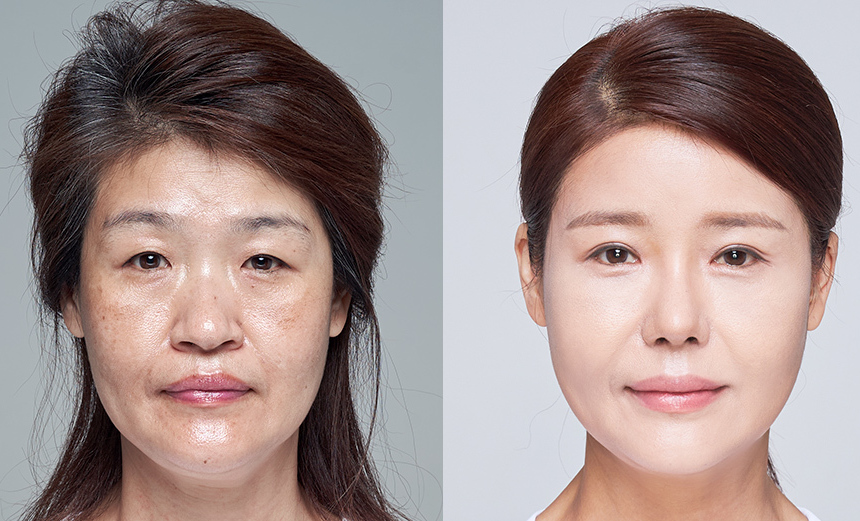 Anti-aging Procedures in Korea