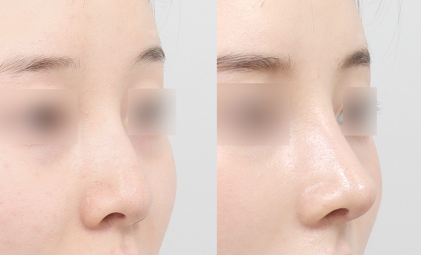 Correction Techniques in Functional Rhinoplasty