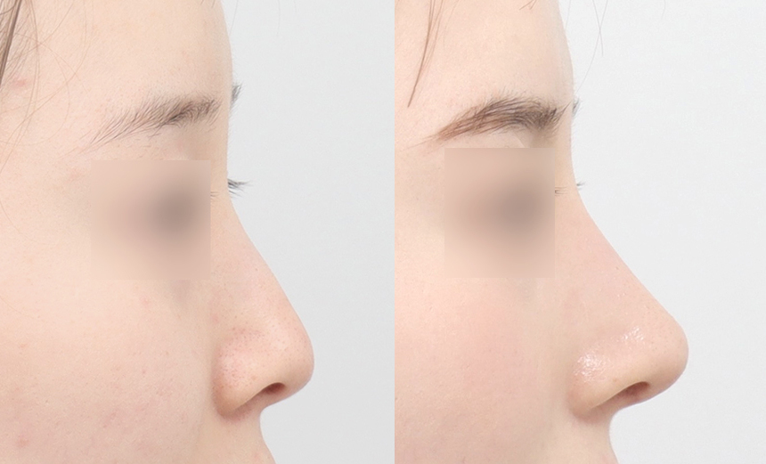 Effectiveness of the Functional Rhinoplasty