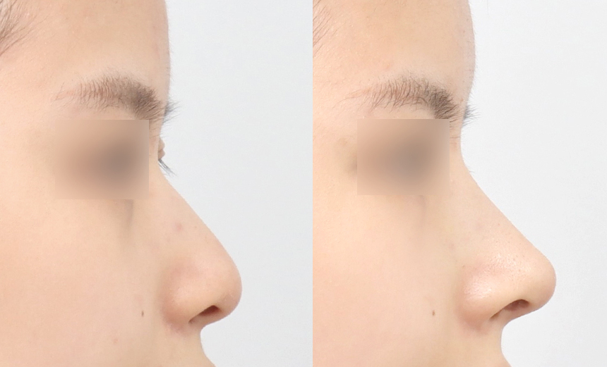 Korean Functional Rhinoplasty