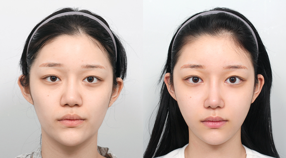 AB Plastic Surgery Korea: Before and After Soft Tissue Contouring​​