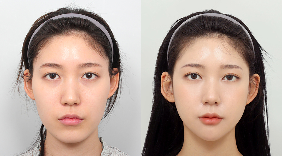 Most Popular Plastic Surgeries in Korea: Square Jaw and Chin Tip Surgery