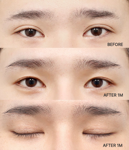 1 Month After Revision Blepharoplasty at AB Plastic Surgery Korea