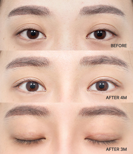 Before and After Revisional Eyelid Surgery at AB Plastic Surgery Korea​​​​