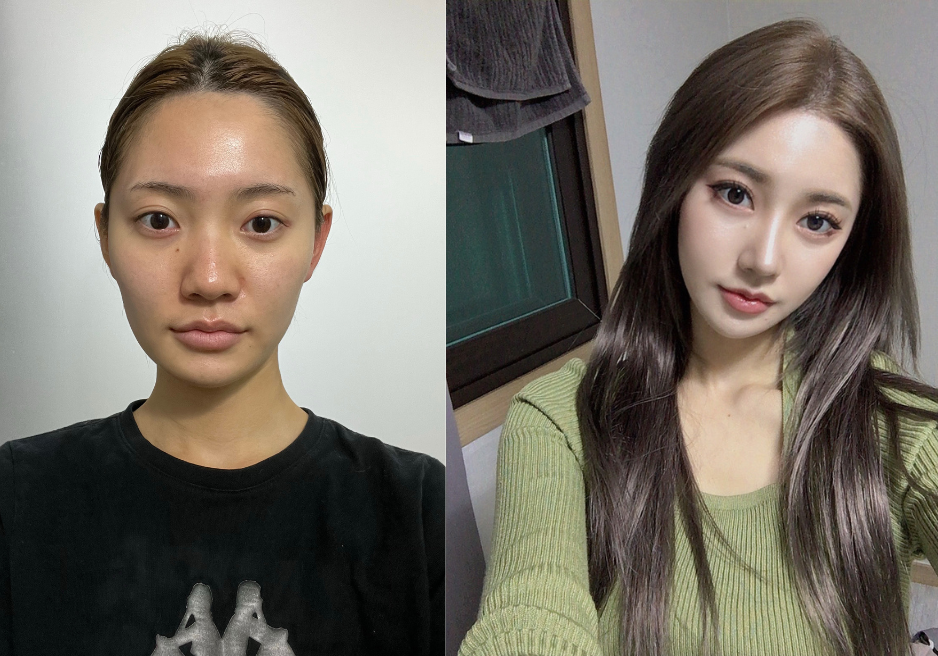 Results of the Rhinoplasty Surgery 