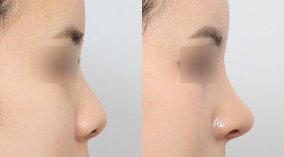 AB Plastic Surgery Rhinoplasty: Before and After