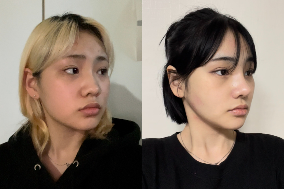 Before and After Jawline Surgery at AB