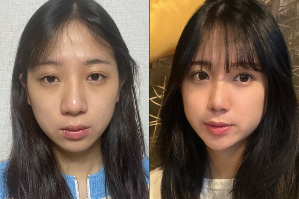 Before and After Plastic Surgery at AB