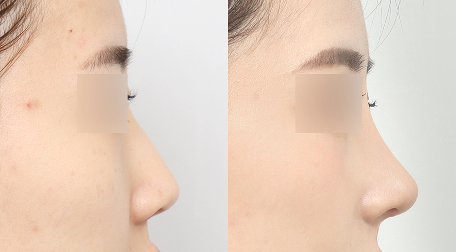 Rhinoplasty Before and After