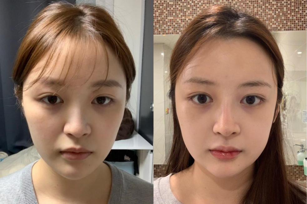 Real Patient Photo AB Plastic Surgery