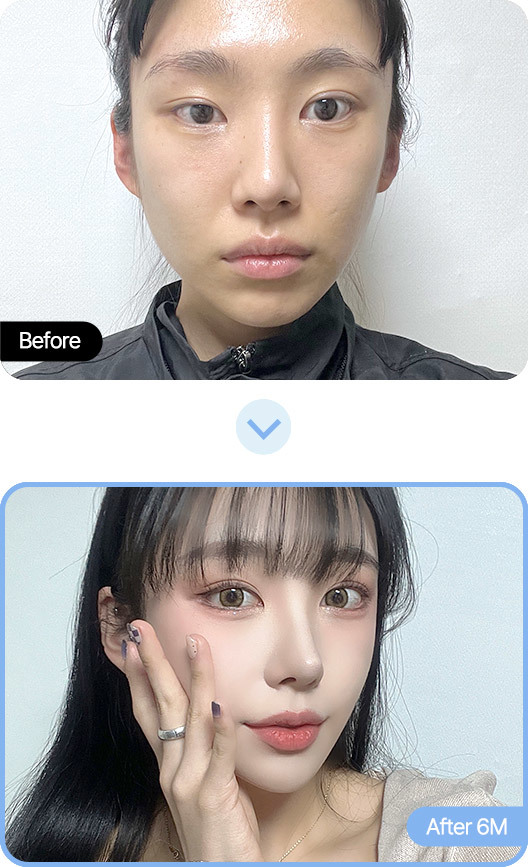 Before and After Double Eyelid Surgery at AB Plastic Surgery