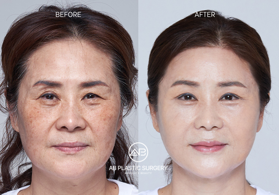 Korean Anti-Aging Procedures