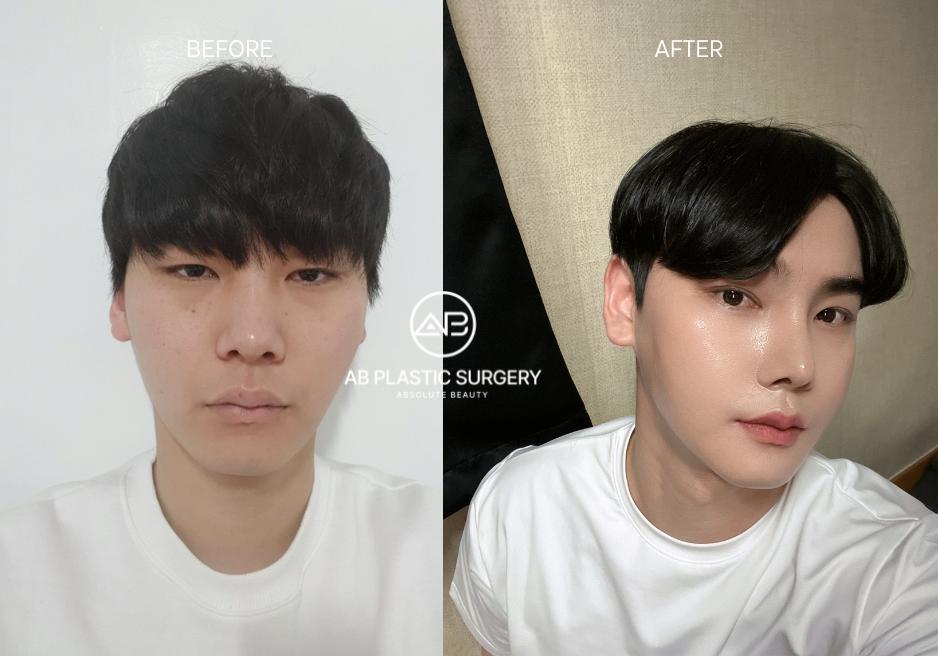 Male Plastic Surgery Korea