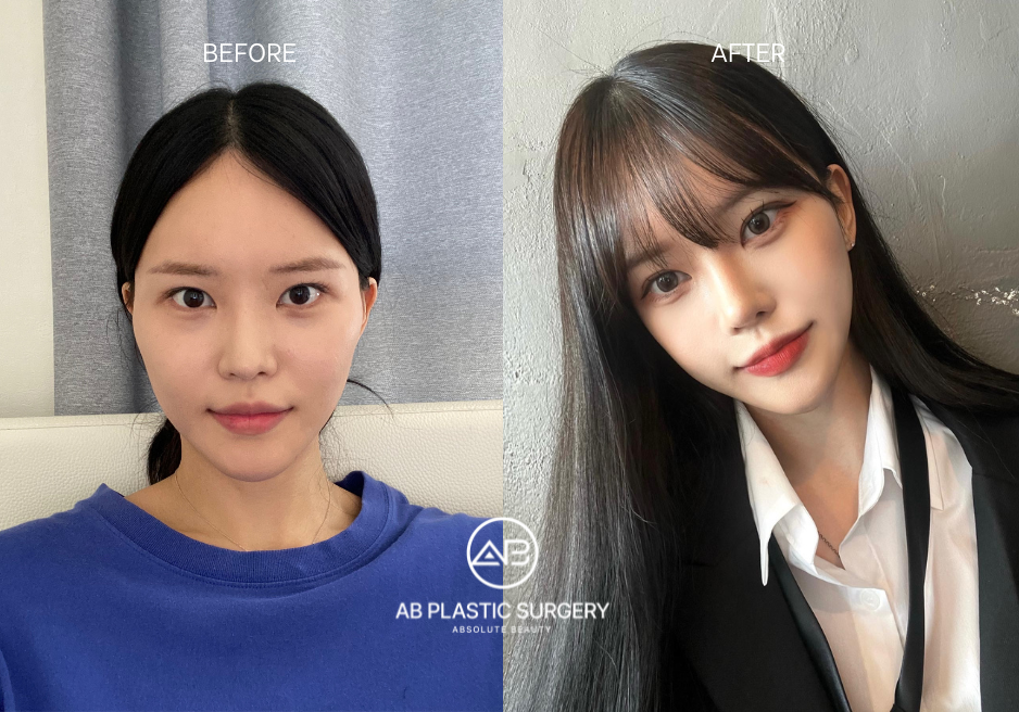 Before and After Korean Plastic Surgery