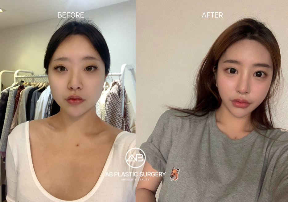 Alar Resection Nose Surgery in Korea