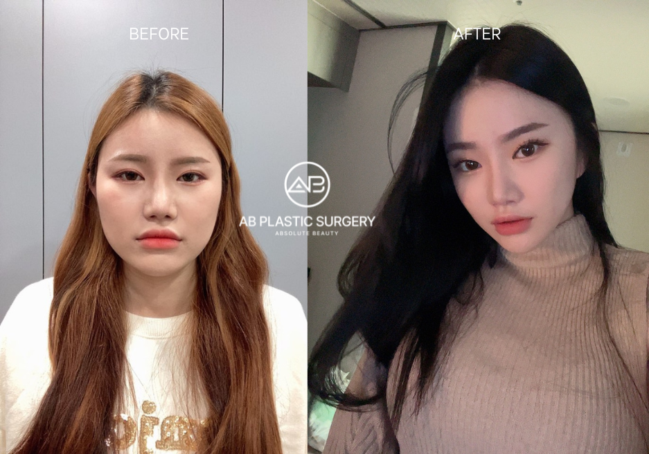 Before and After Square Jaw Surgery at AB Plastic Surgery