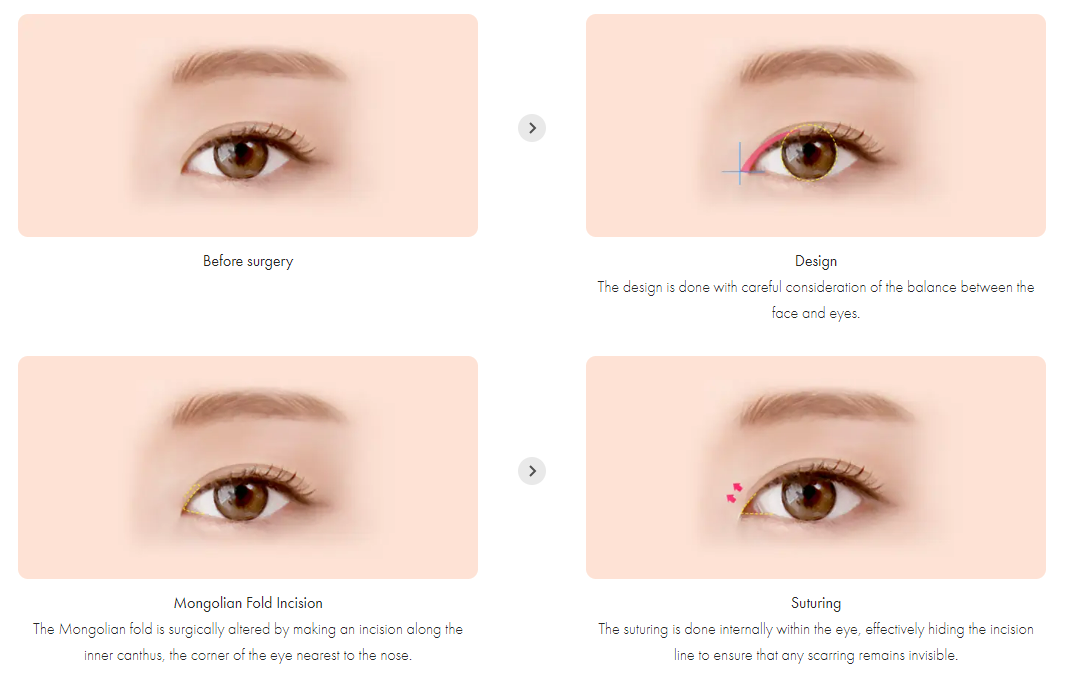 How Epicanthoplasty Is Done
