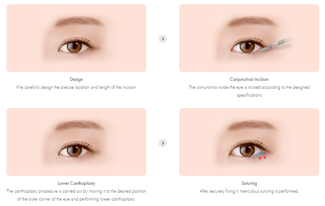 Lower Canthoplasty in Korea