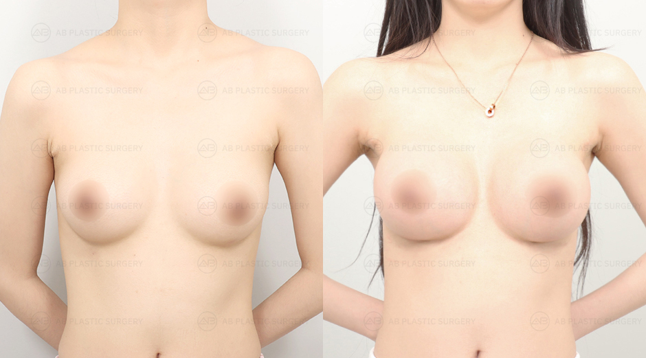 Before and After Breast Surgery at AB