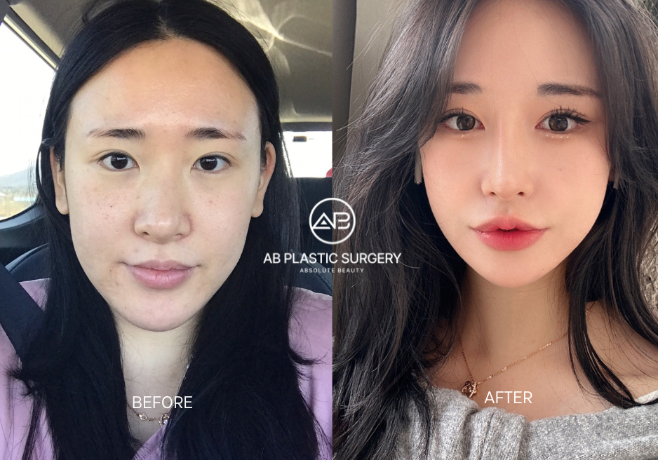 Before and After Korean Nose and V-line Plastic Surgery