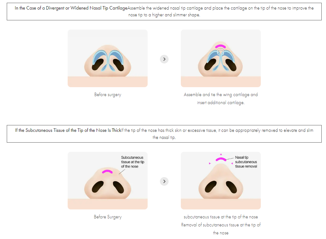 Bulbous Nose Surgery Korea