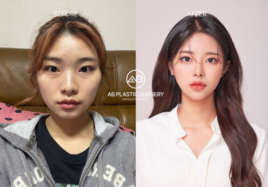 Plastic Surgery Korea, Before and After