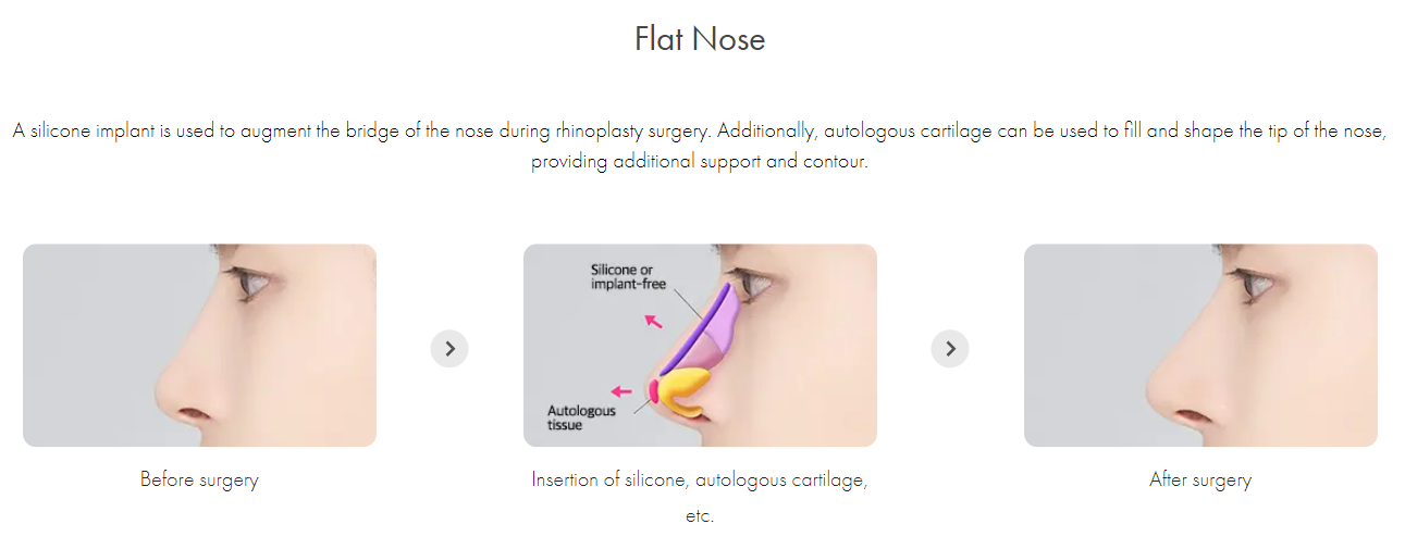 Male Flat Nose Surgery Korea