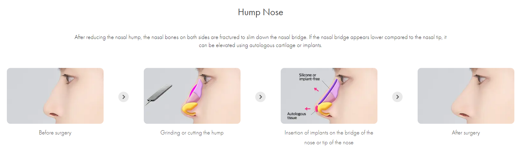 Male Hump Nose Surgery Korea