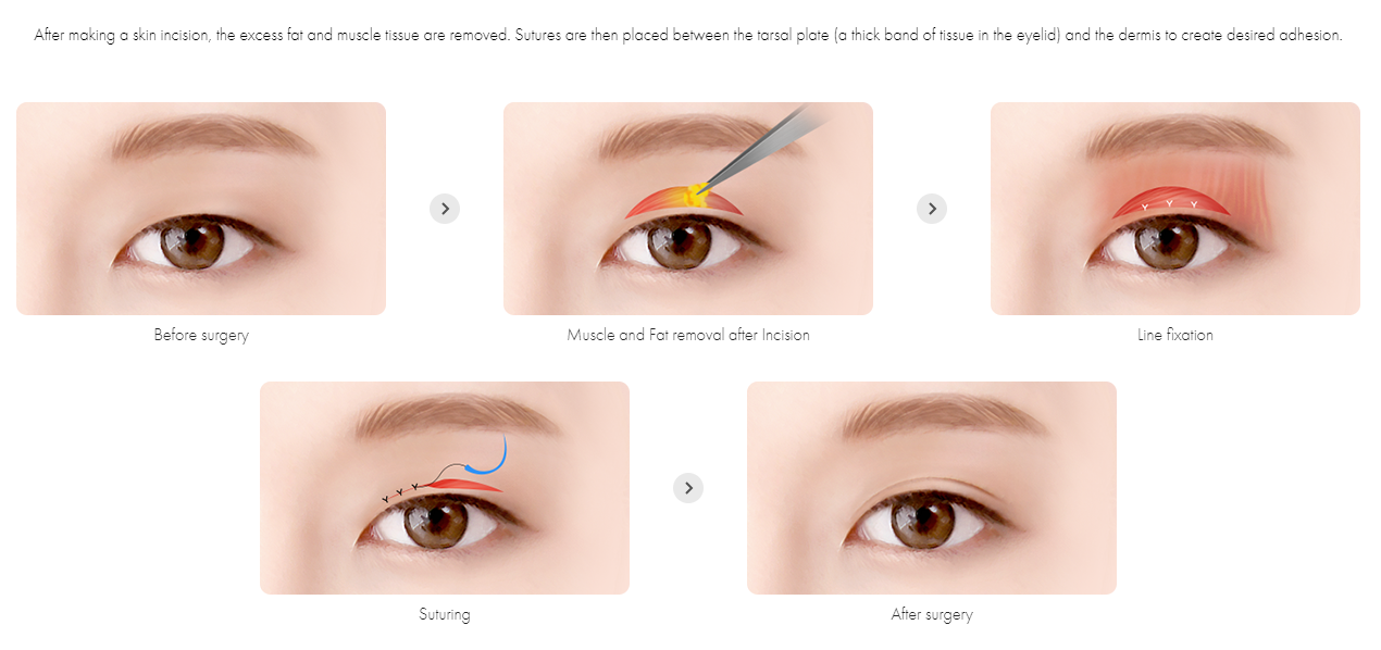 Incisional Double Eyelid Surgery 
