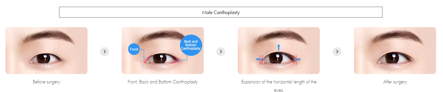 Male Eye Surgery Korea