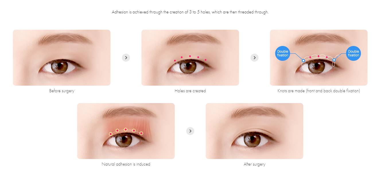 Non-incisional Double Eyelid Surgery 