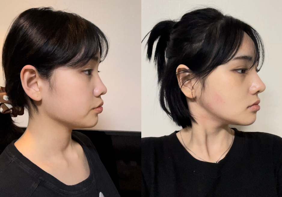 Before and After Square Jaw Surgery