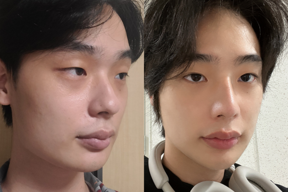 Male Plastic Surgery in Korea