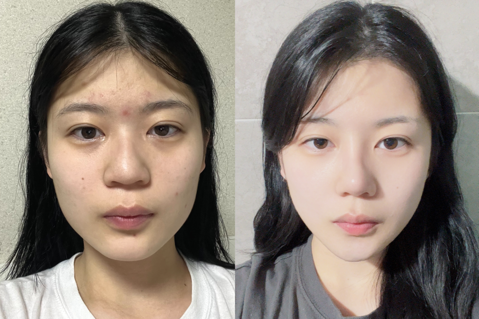 Alar Resection at AB Plastic Surgery Korea