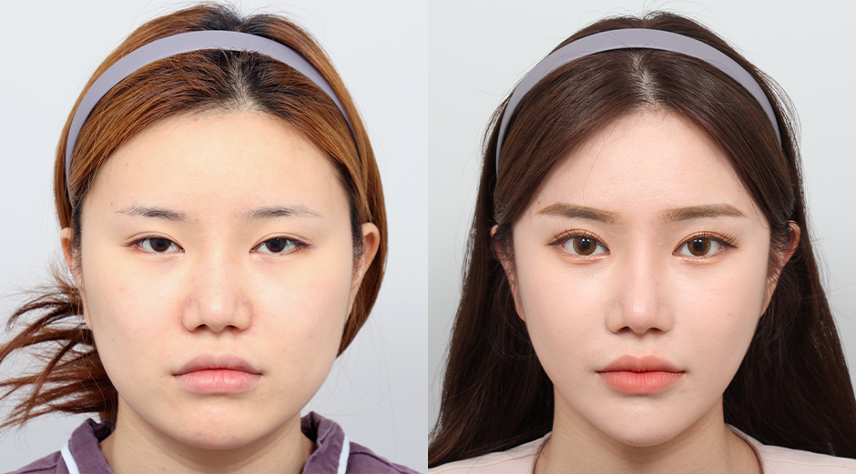 Before and After Plastic Surgery in Korea