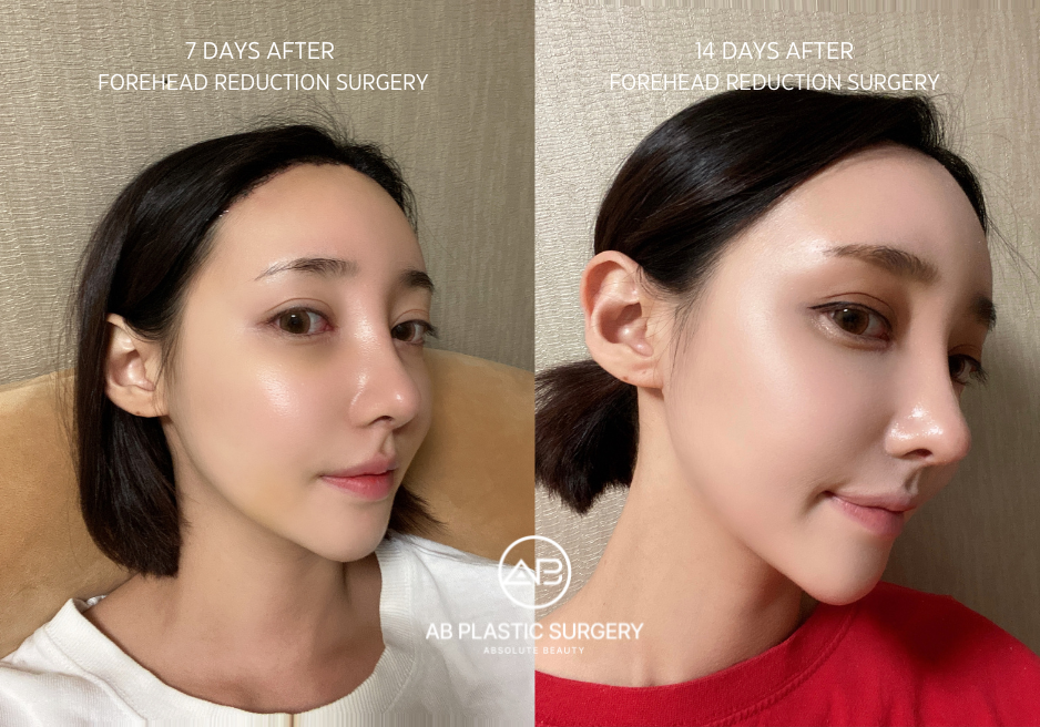 Results of Forehead Reduction Surgery at AB Plastic Surgery Korea