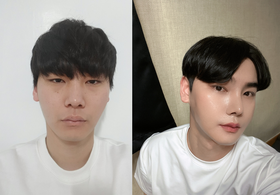 Male Plastic Surgery in Korea