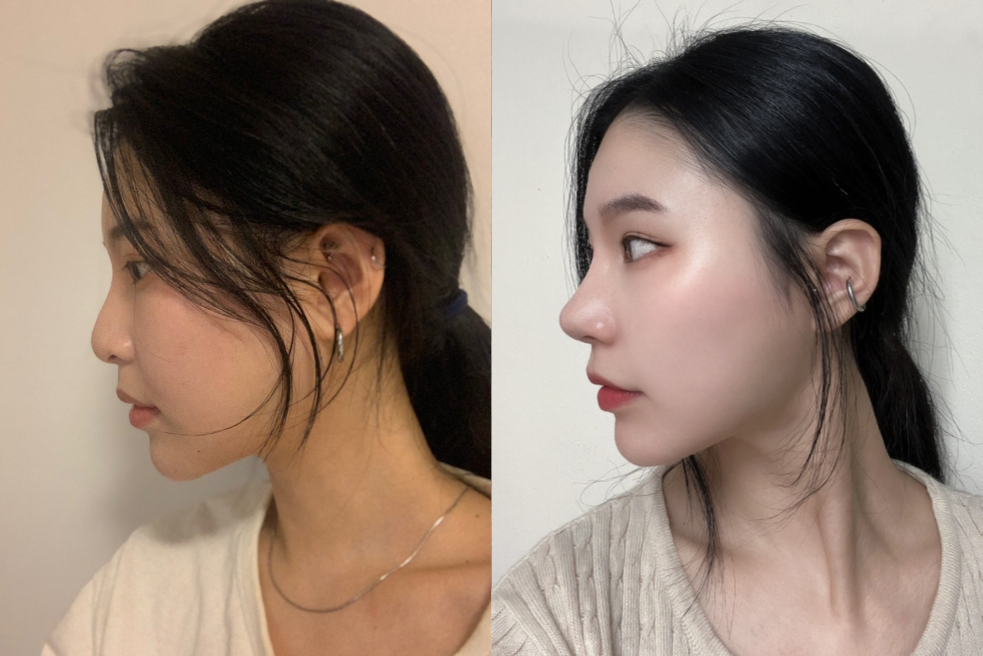 Rhinoplasty in Korea, Before and After