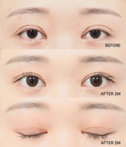 Revisional Eye Surgery Korea