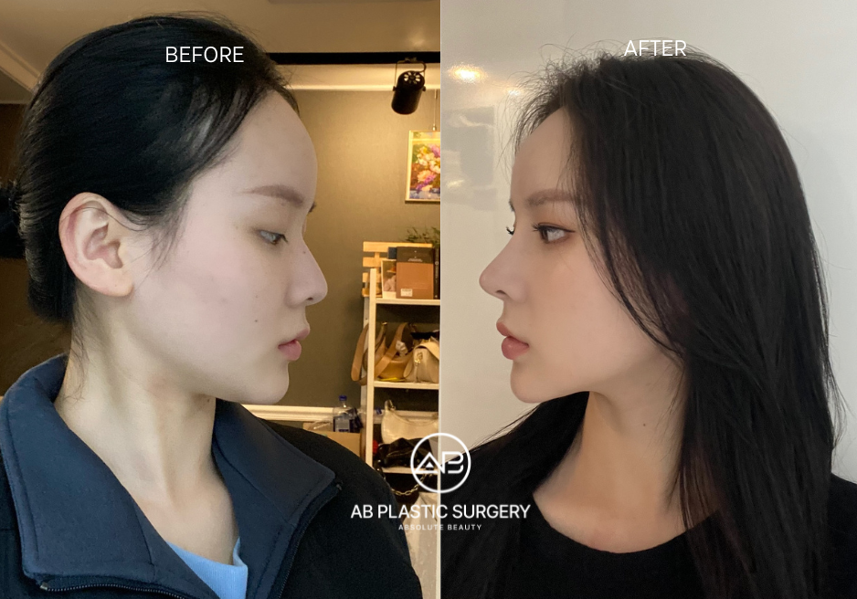 Double Chin Surgery Korea