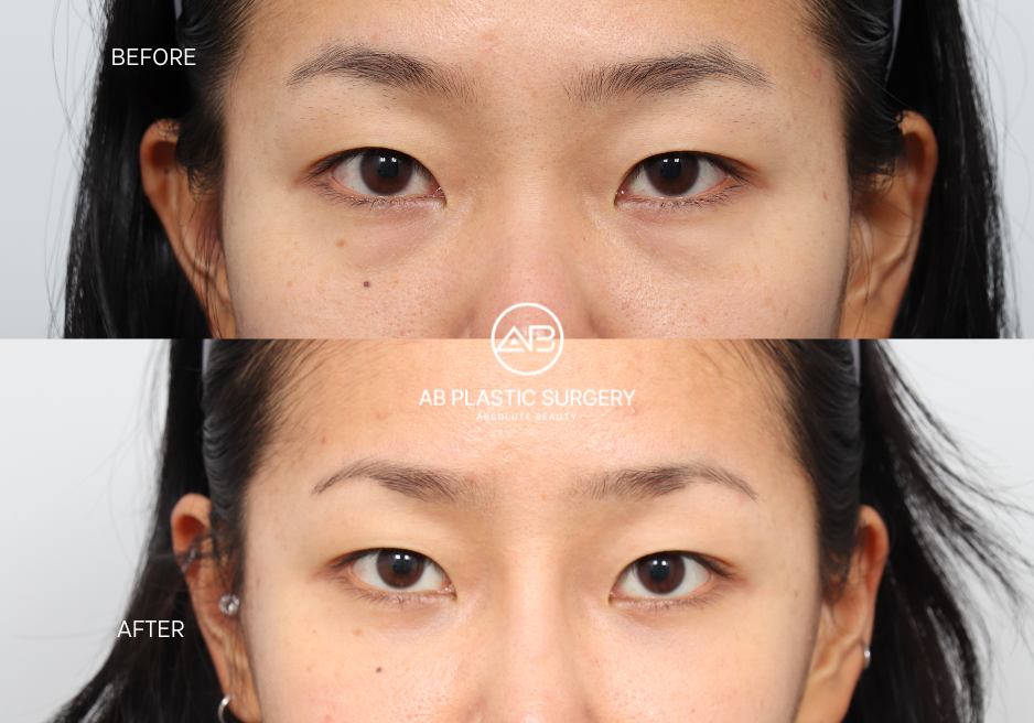 Eye Bag Removal Surgery in Korea