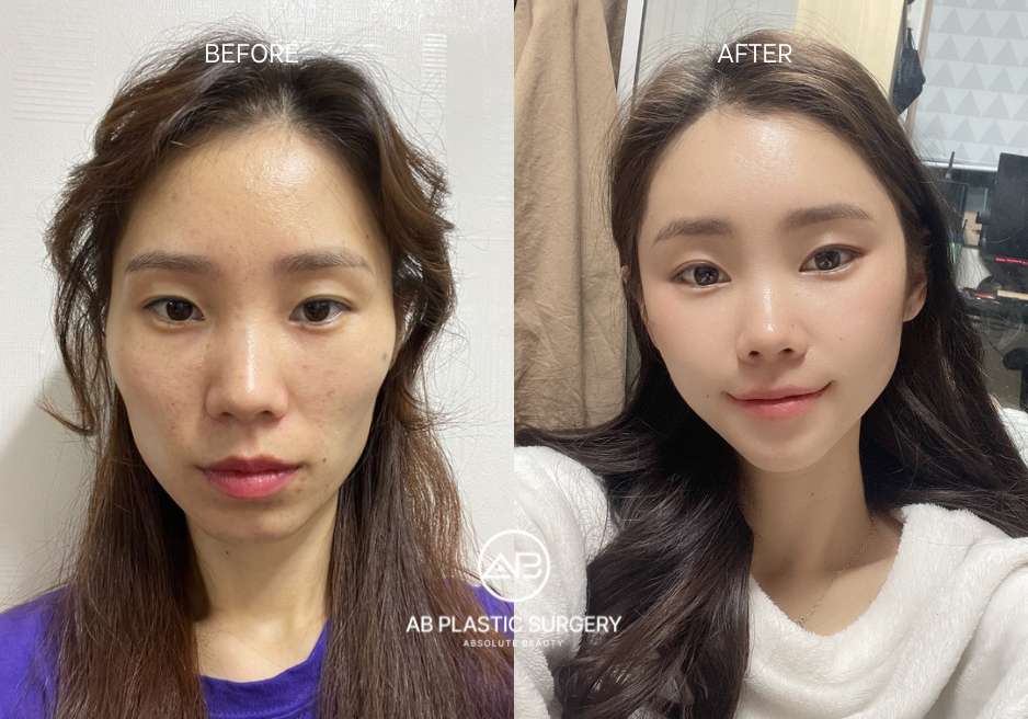 Facial Contouring Korea