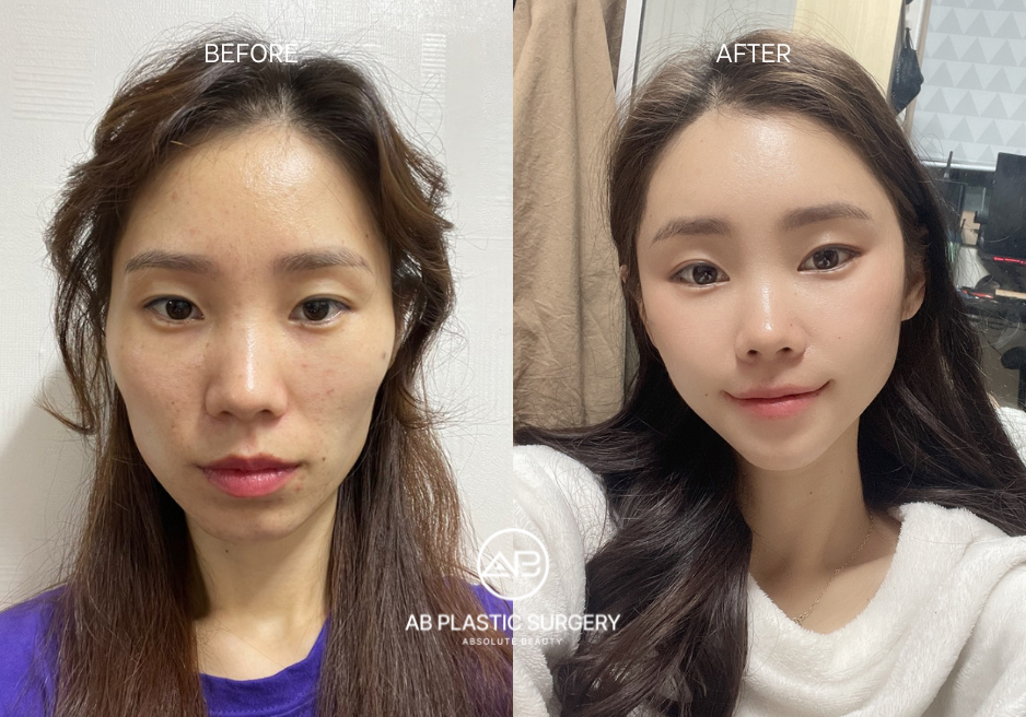 Facial Contoiuring Before and After