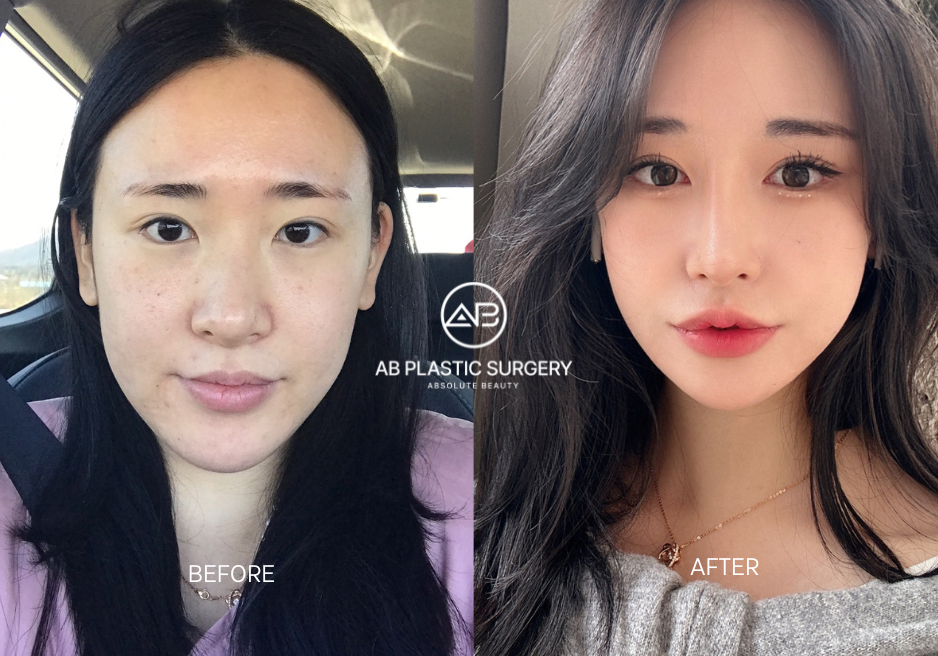 korea alar resection before and after