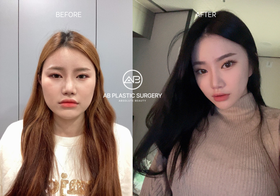 V-line Face Surgery in Korea