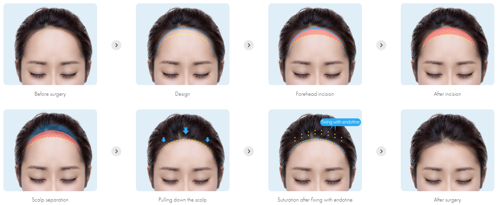 How Forehead Reduction Surgery Is Done