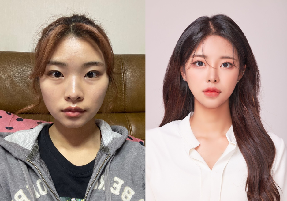 Before and After Korean Plastic Surgery